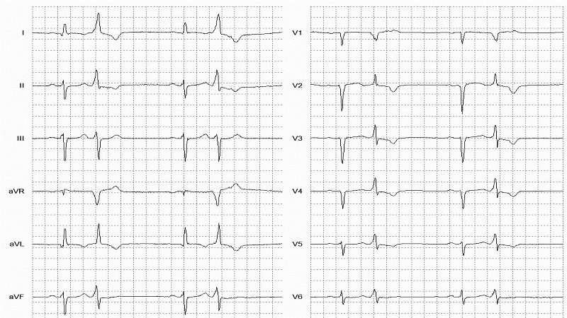 Ventricular Bigeminy 12 Lead EKG